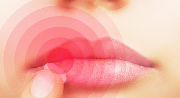 What Triggers Your Cold Sores?
