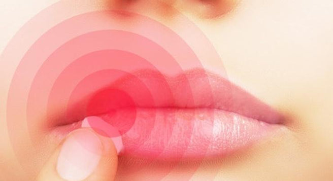 Take control of cold sores