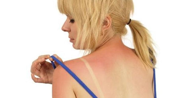How to soothe your sunburnt damaged skin