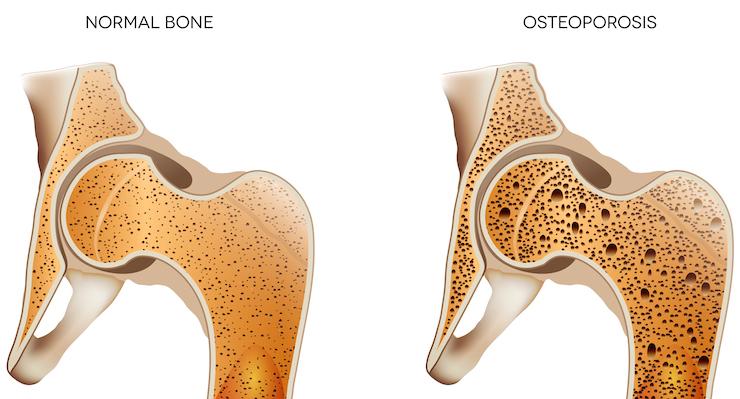 How strong and healthy are your bones?