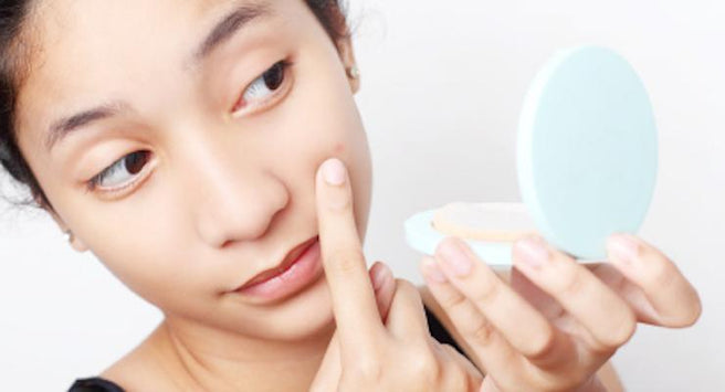 Teenage Acne and Problem Skin Solutions